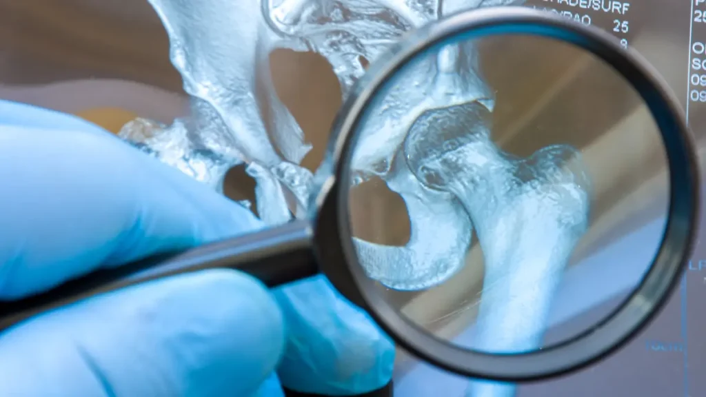 Como conviver com artrose no quadril