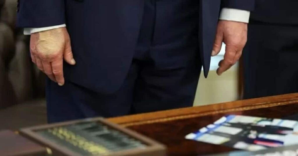 Trump retoca mão para esconder problemas de saúde Trump retoca mão para esconder problemas de saúde